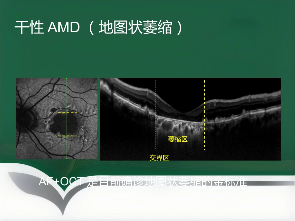 OCT影像技术的临床应用_第15页