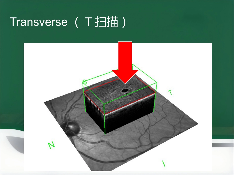 OCT影像技术的临床应用_第7页