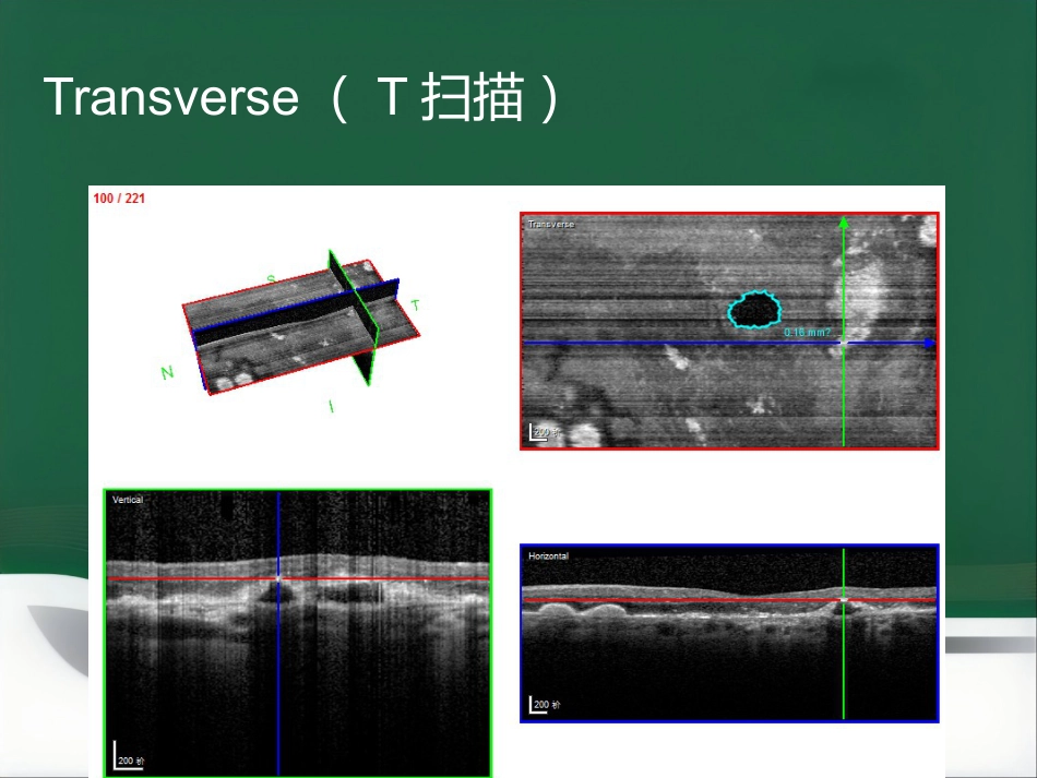 OCT影像技术的临床应用_第8页