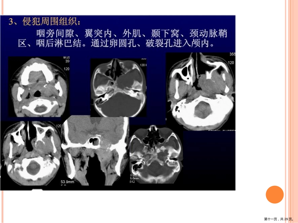 鼻咽癌影像诊断PPT_第11页