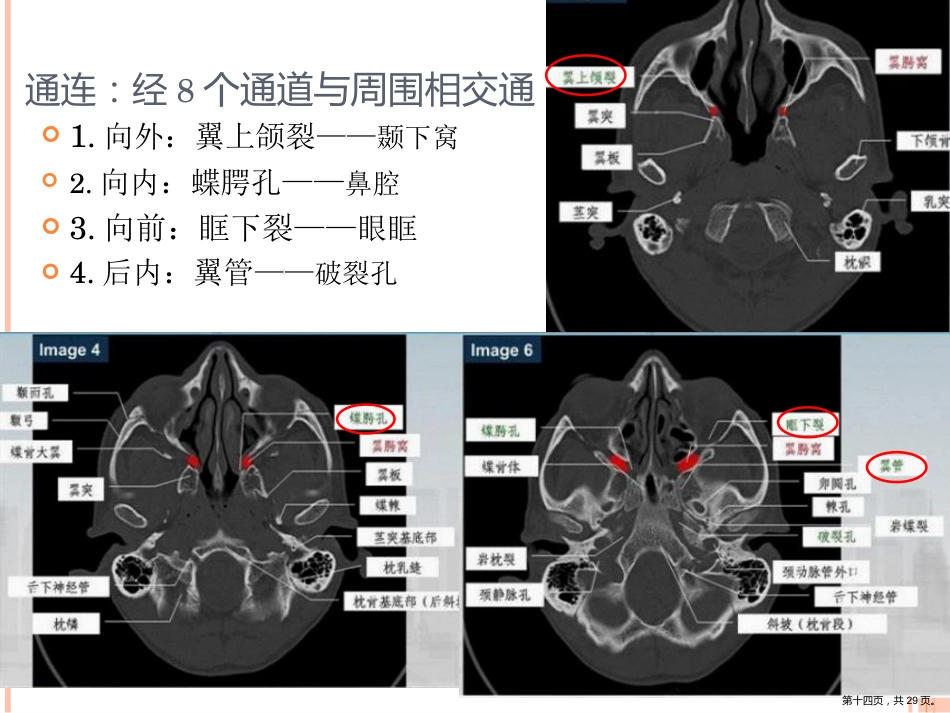 鼻咽癌影像诊断PPT_第14页