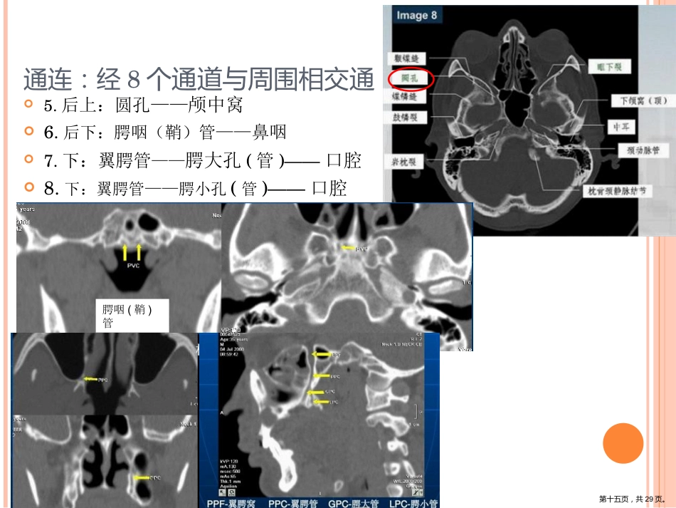 鼻咽癌影像诊断PPT_第15页