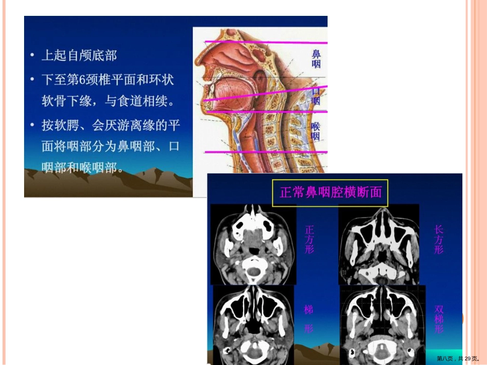 鼻咽癌影像诊断PPT_第8页