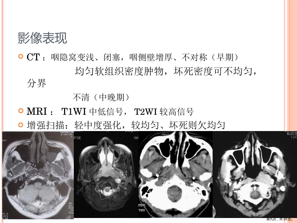 鼻咽癌影像诊断PPT_第9页