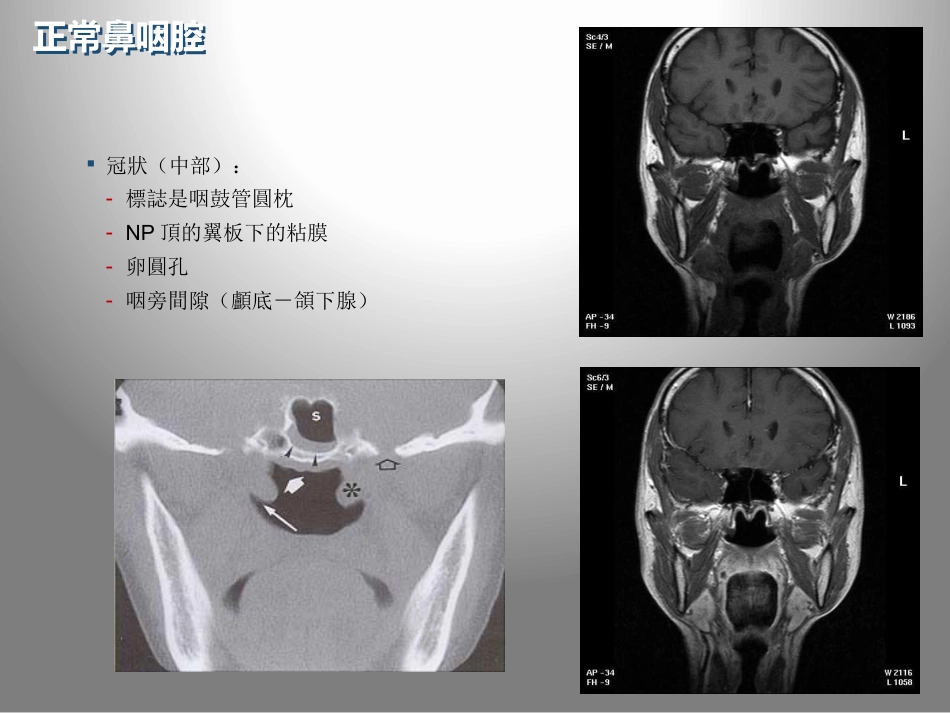 鼻咽癌的影像学诊断_第10页
