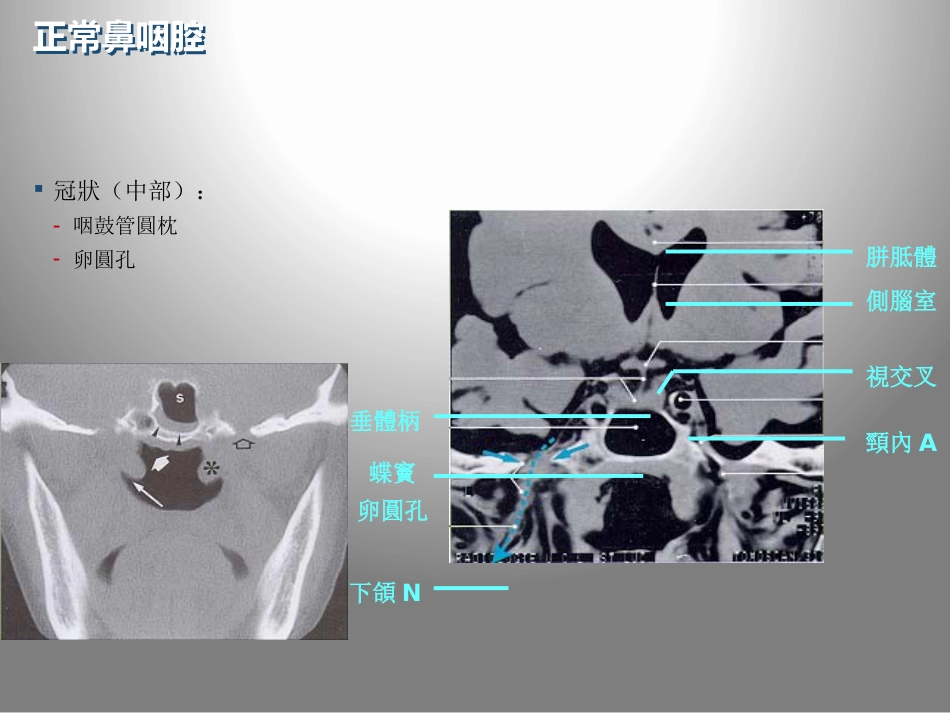 鼻咽癌的影像学诊断_第11页