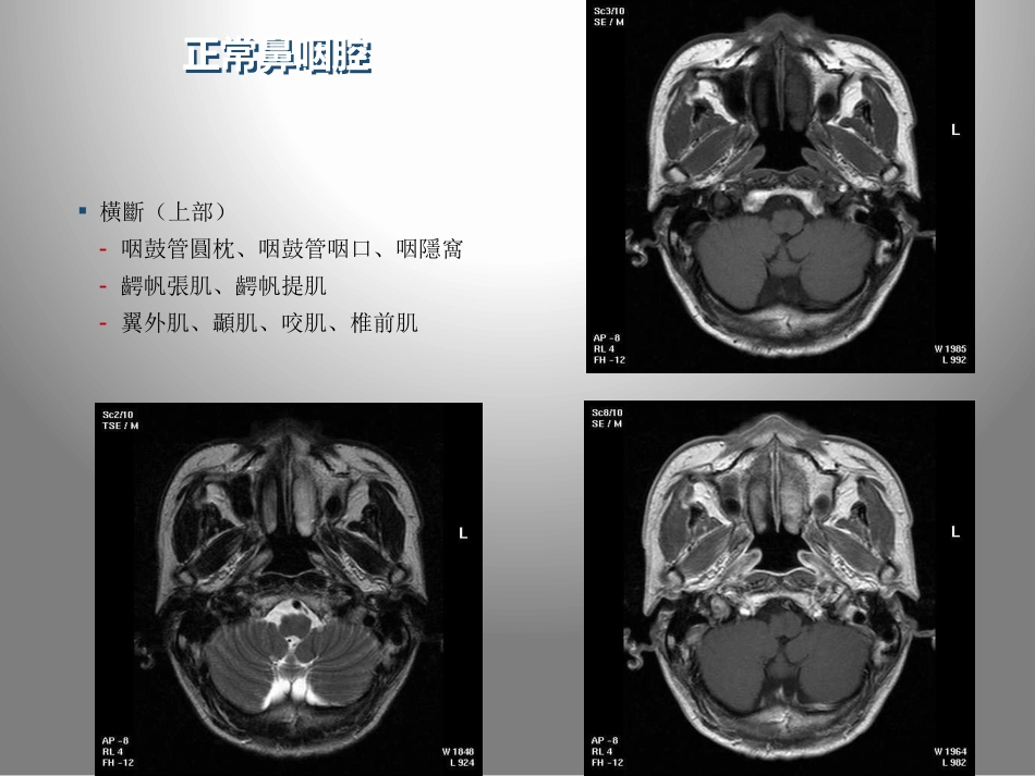 鼻咽癌的影像学诊断_第7页