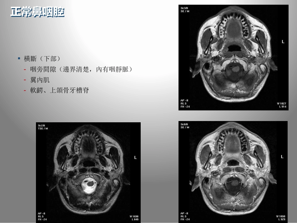 鼻咽癌的影像学诊断_第8页