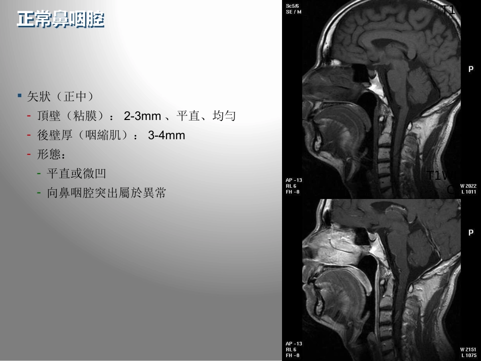 鼻咽癌的影像学诊断_第9页