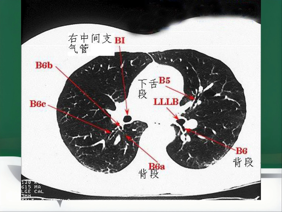 du 肺炎的影像学诊断_第11页