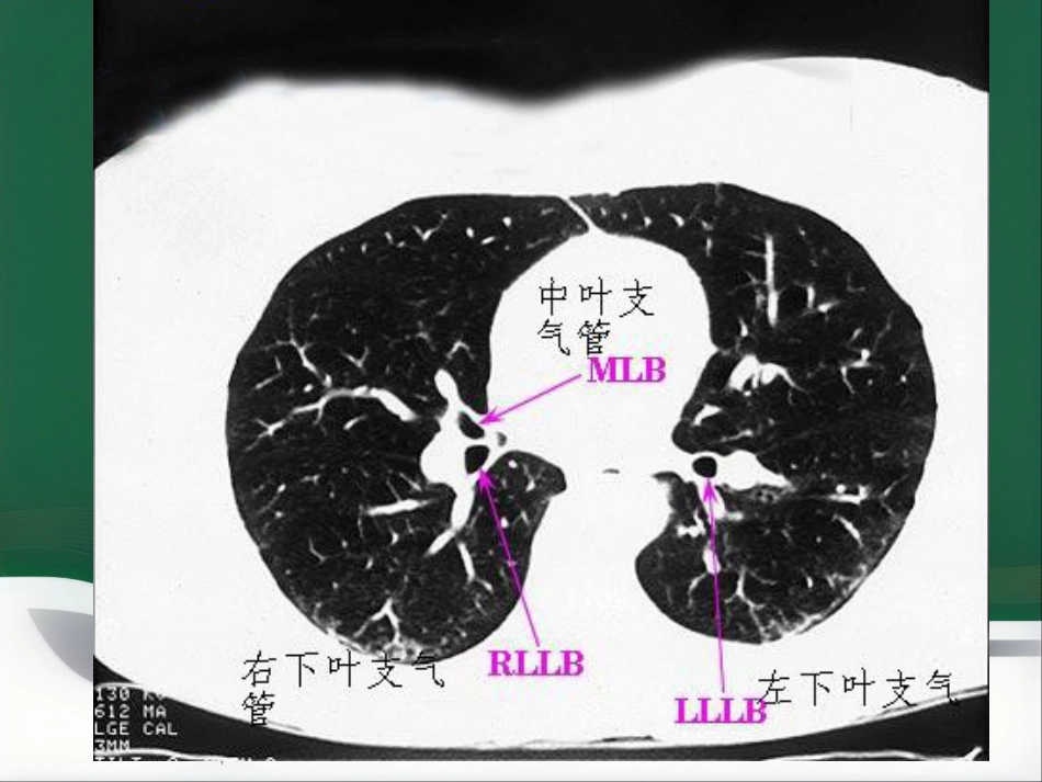 du 肺炎的影像学诊断_第12页