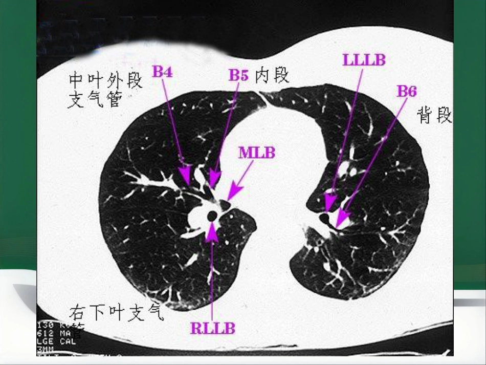 du 肺炎的影像学诊断_第13页