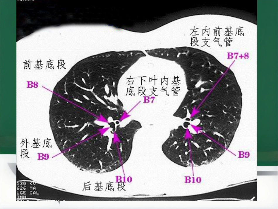 du 肺炎的影像学诊断_第14页