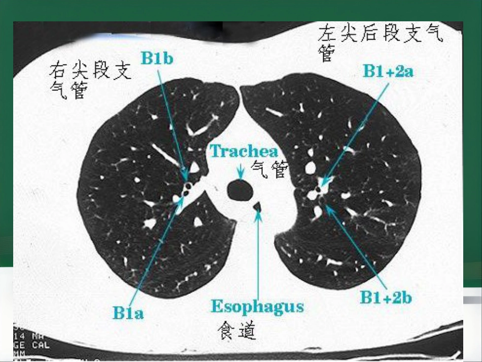du 肺炎的影像学诊断_第5页
