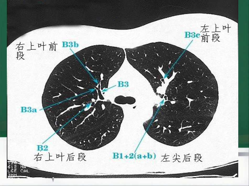 du 肺炎的影像学诊断_第6页