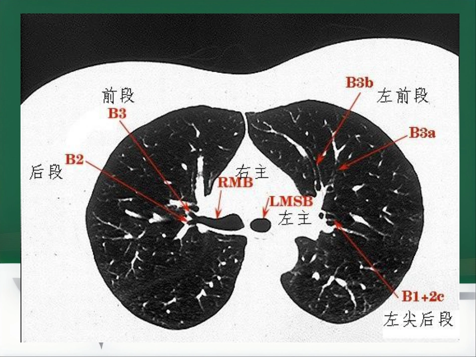 du 肺炎的影像学诊断_第7页
