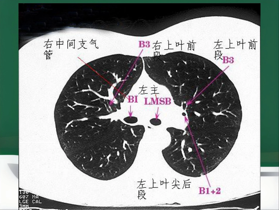 du 肺炎的影像学诊断_第8页