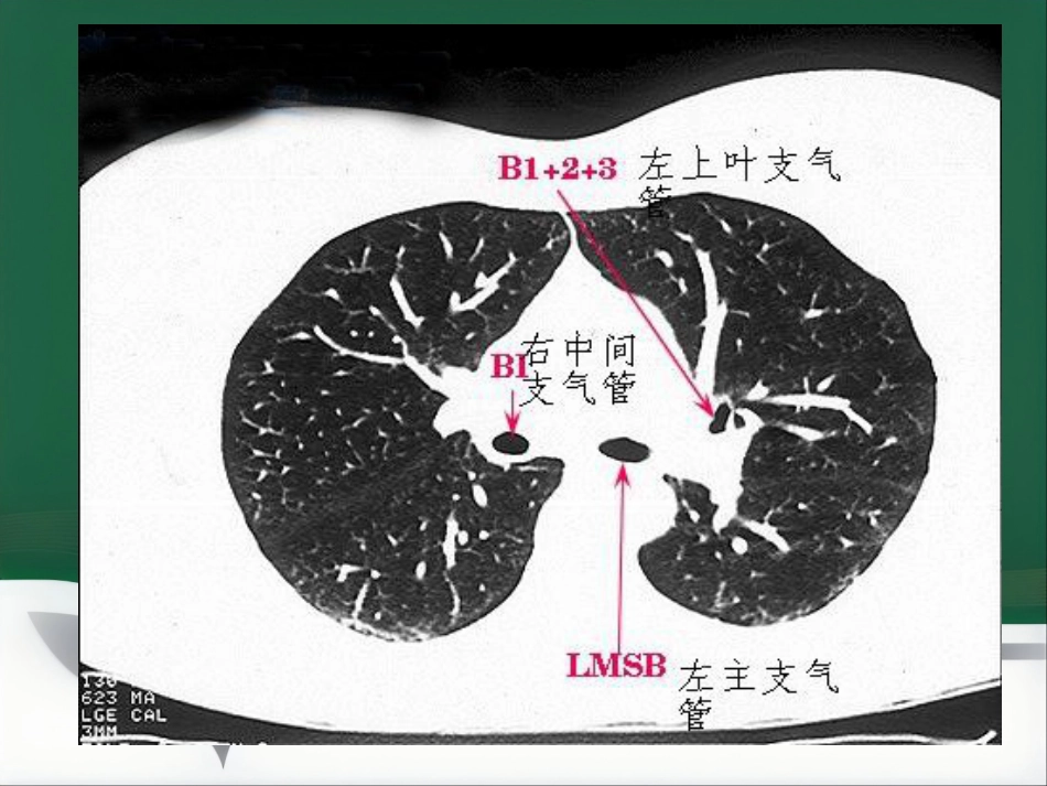 du 肺炎的影像学诊断_第9页