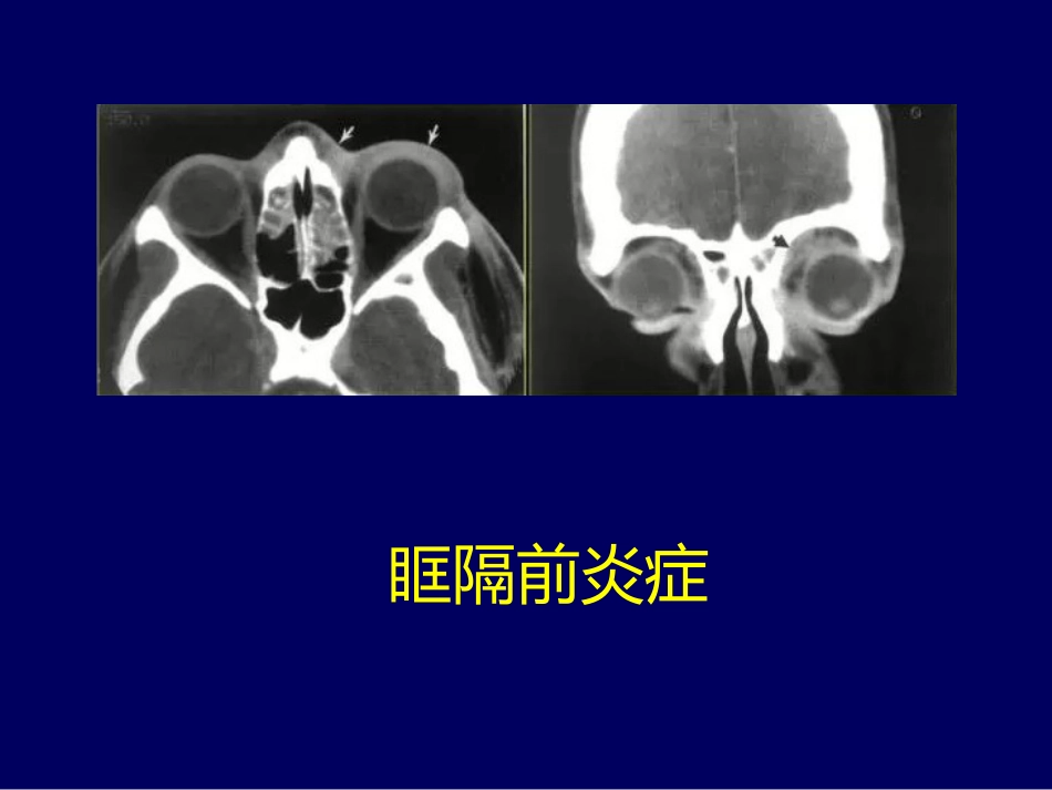 常见眼眶内肿瘤的影像诊断分析 ppt课件_第12页