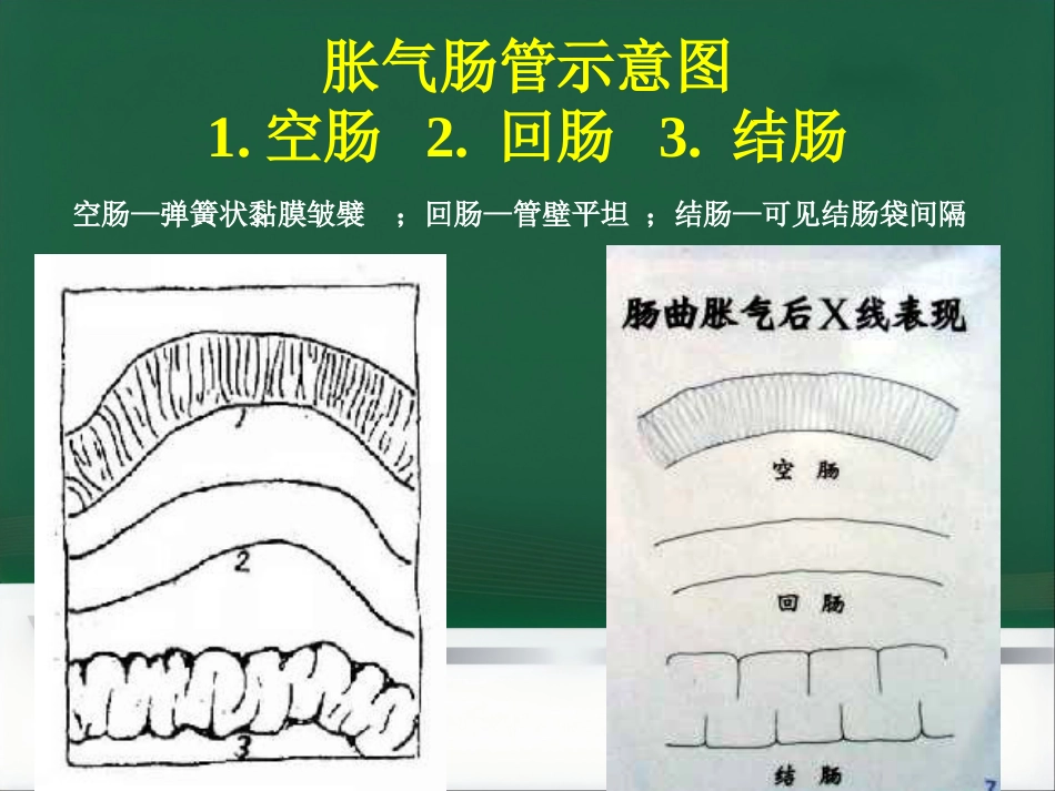 肠梗阻的分类及影像学表现_第8页