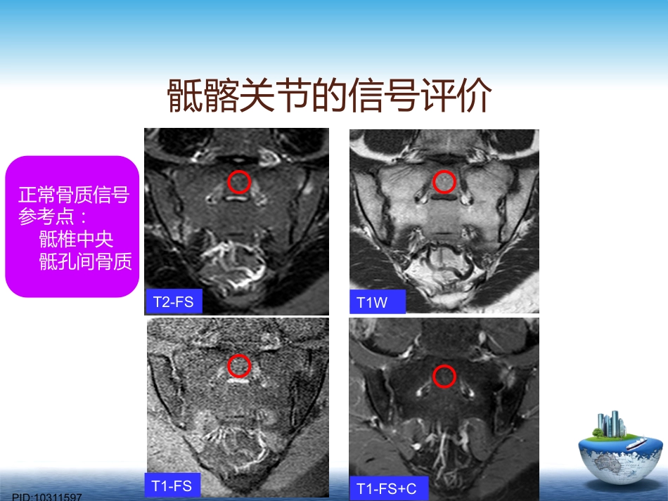 SpA骶髂关节炎的影像学诊断和鉴别诊断课件_第11页