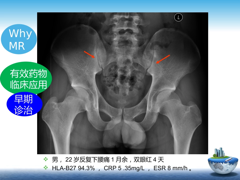 SpA骶髂关节炎的影像学诊断和鉴别诊断课件_第4页