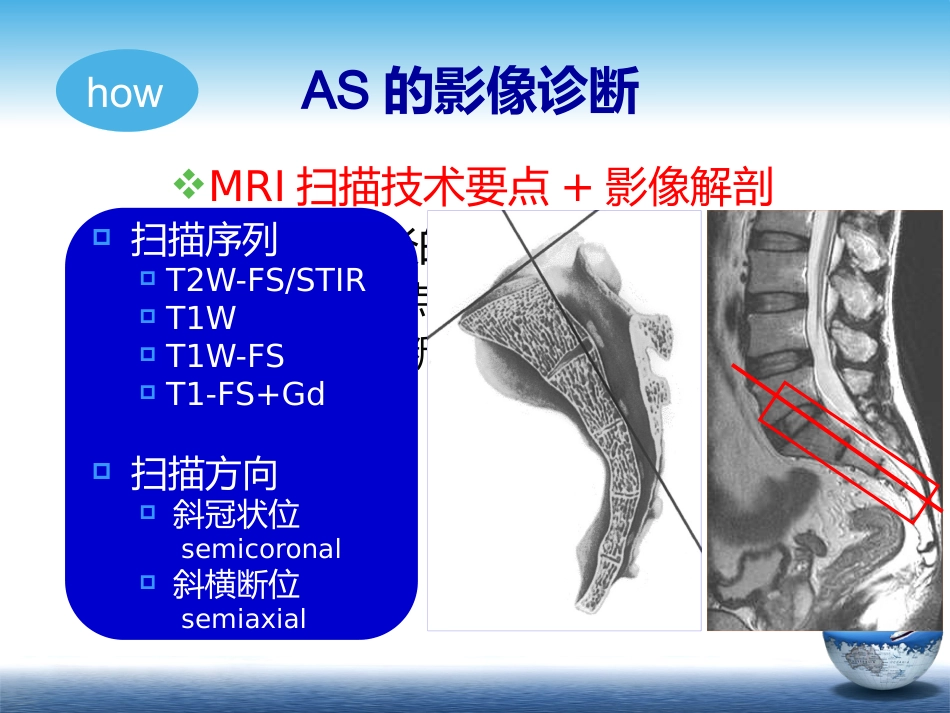 SpA骶髂关节炎的影像学诊断和鉴别诊断课件_第8页