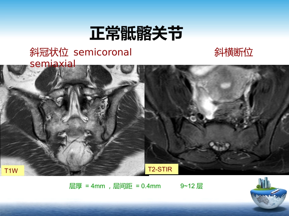 SpA骶髂关节炎的影像学诊断和鉴别诊断课件_第9页
