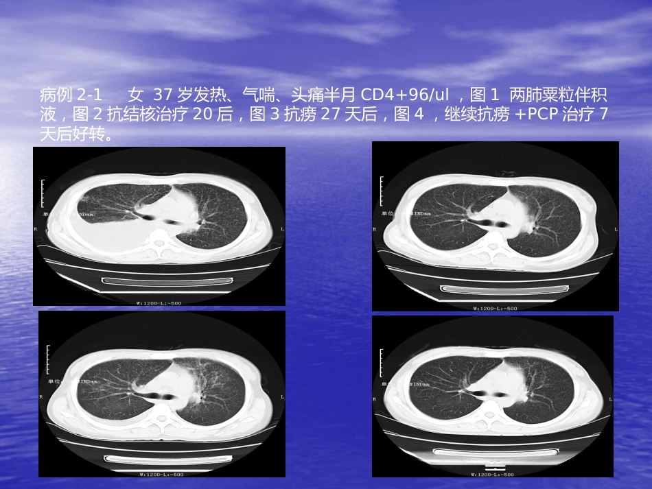 艾滋病相关性胸部影像学表现_第13页
