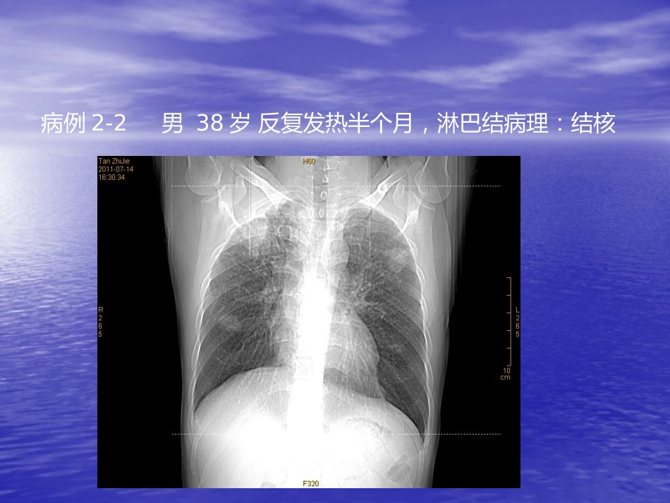 艾滋病相关性胸部影像学表现_第14页