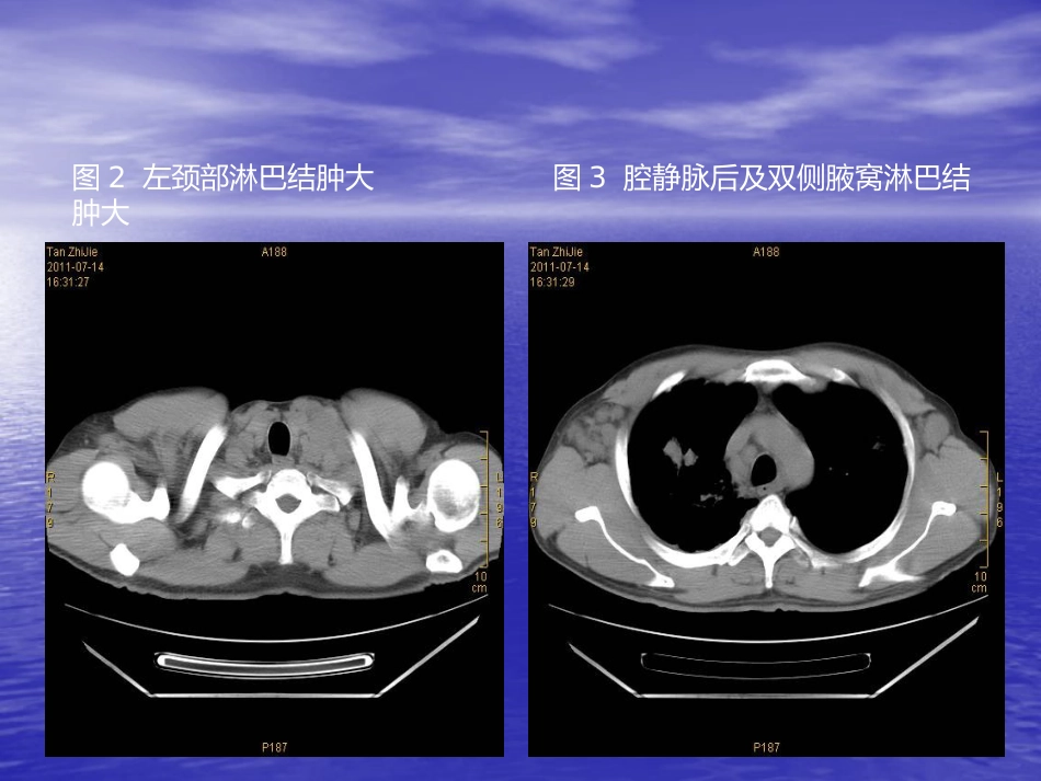 艾滋病相关性胸部影像学表现_第15页