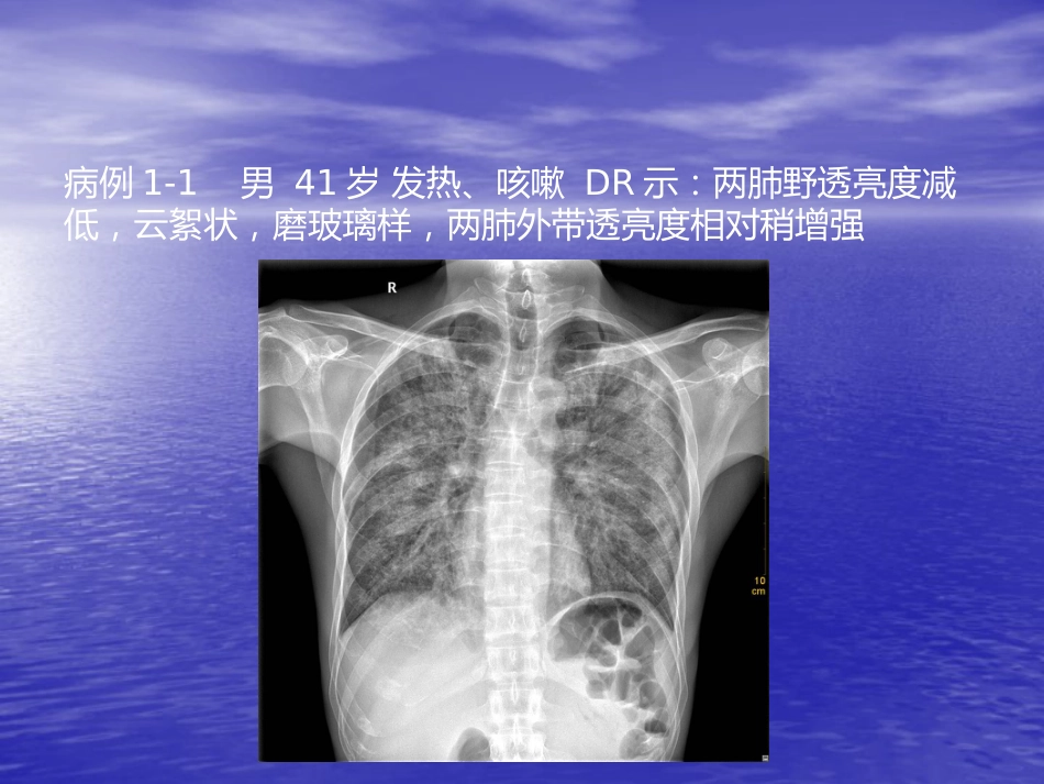 艾滋病相关性胸部影像学表现_第4页