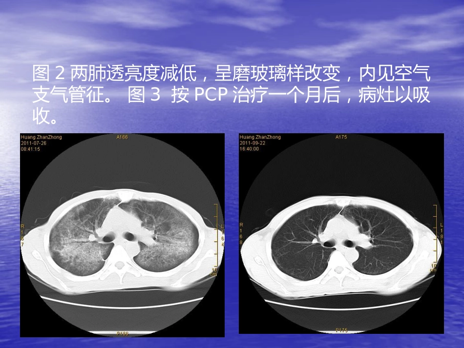 艾滋病相关性胸部影像学表现_第5页