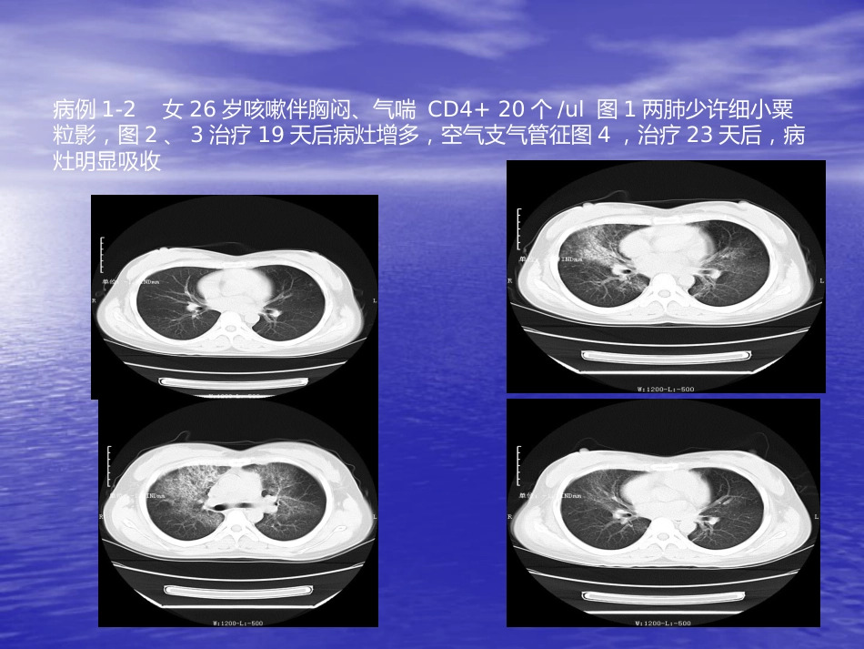 艾滋病相关性胸部影像学表现_第6页