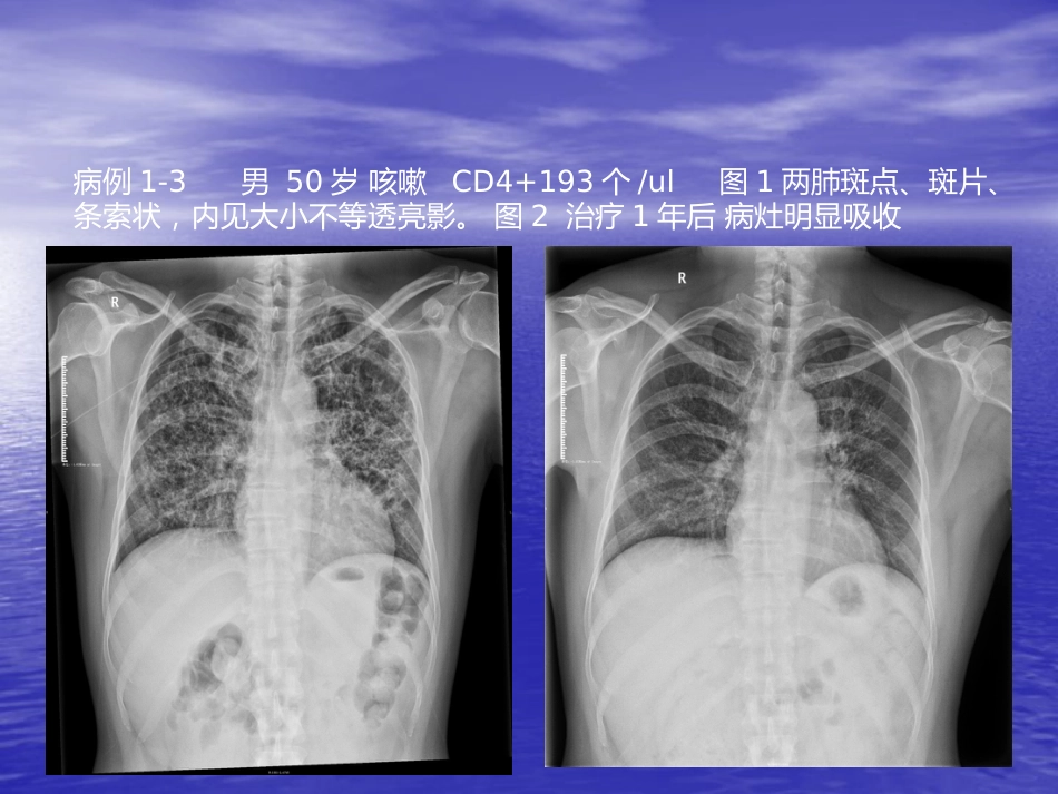 艾滋病相关性胸部影像学表现_第7页