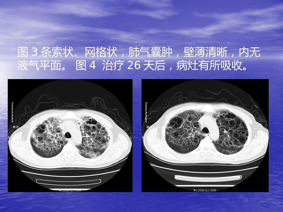 艾滋病相关性胸部影像学表现_第8页