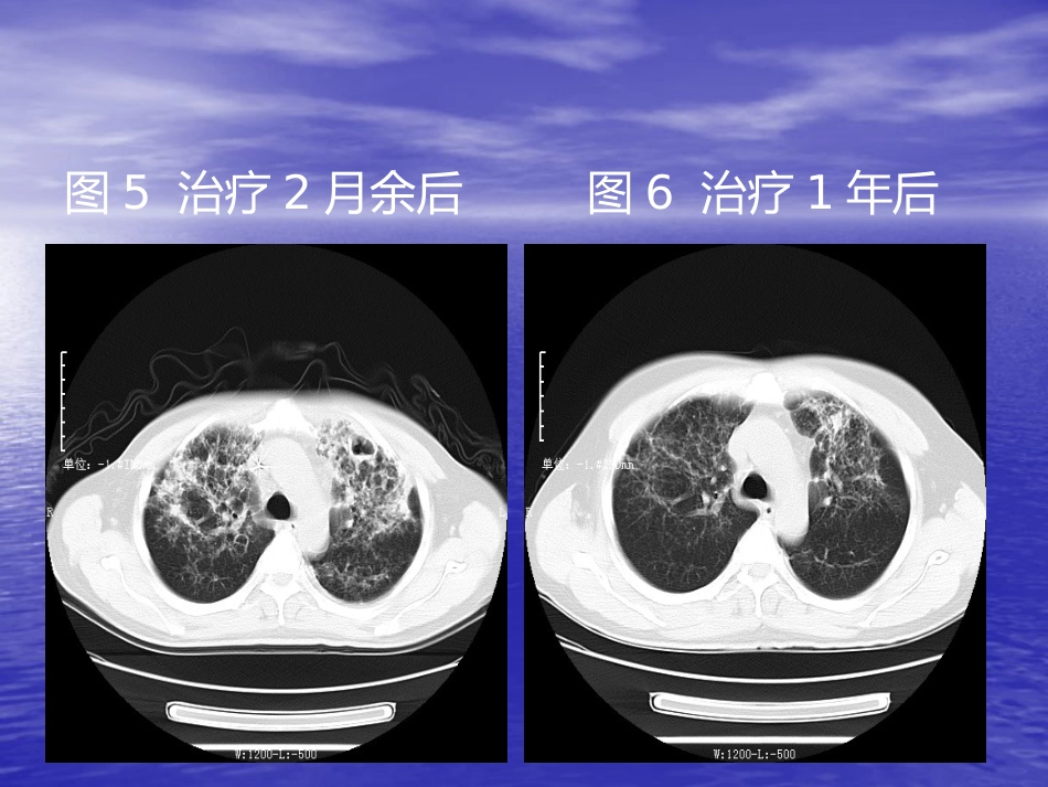 艾滋病相关性胸部影像学表现_第9页