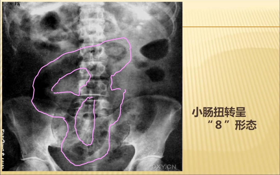 肠梗阻的影像诊断医学PPT_第12页