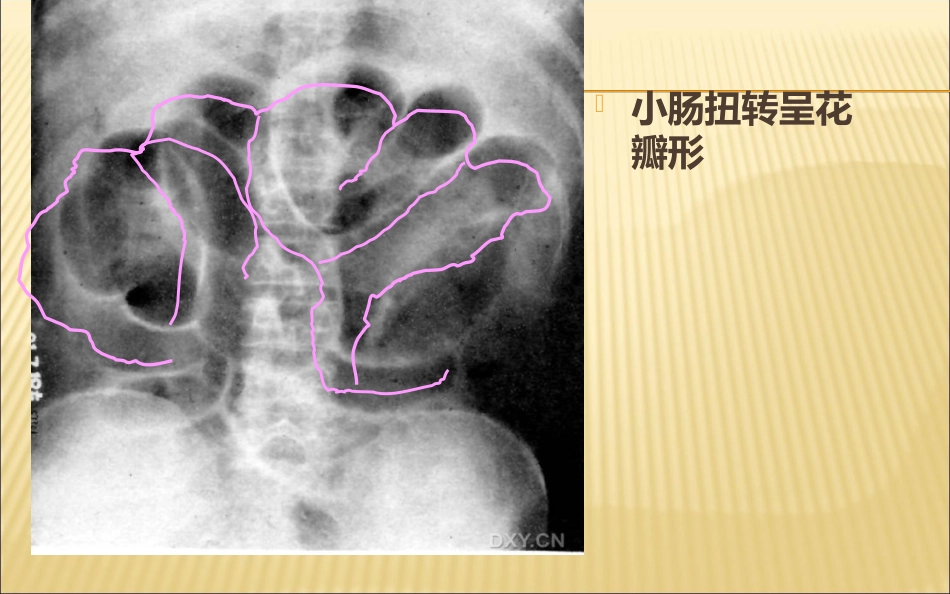 肠梗阻的影像诊断医学PPT_第13页