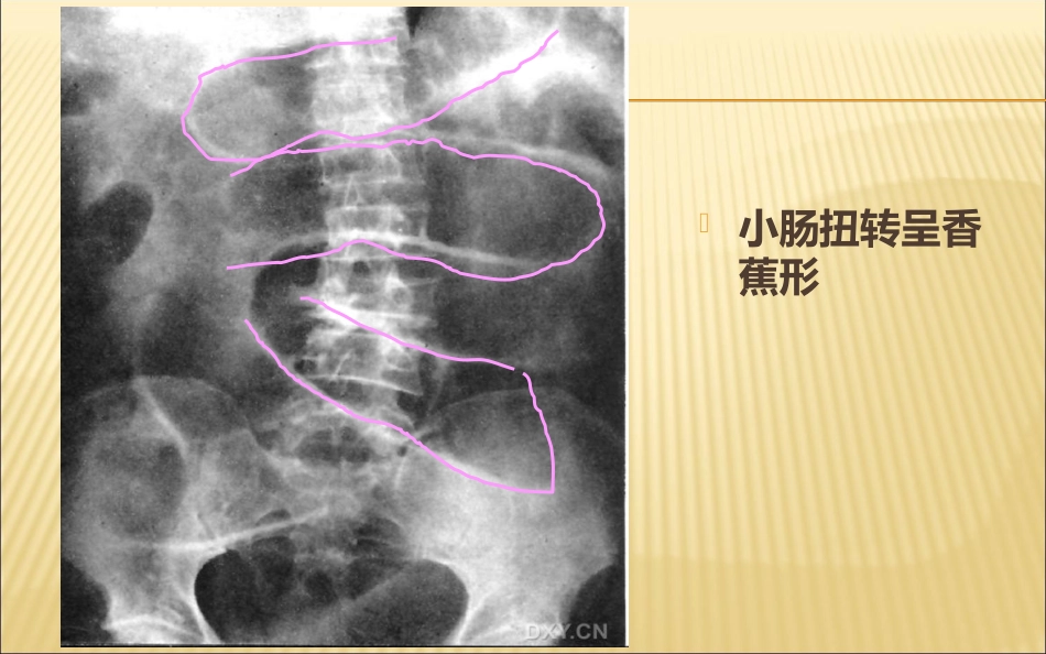肠梗阻的影像诊断医学PPT_第14页