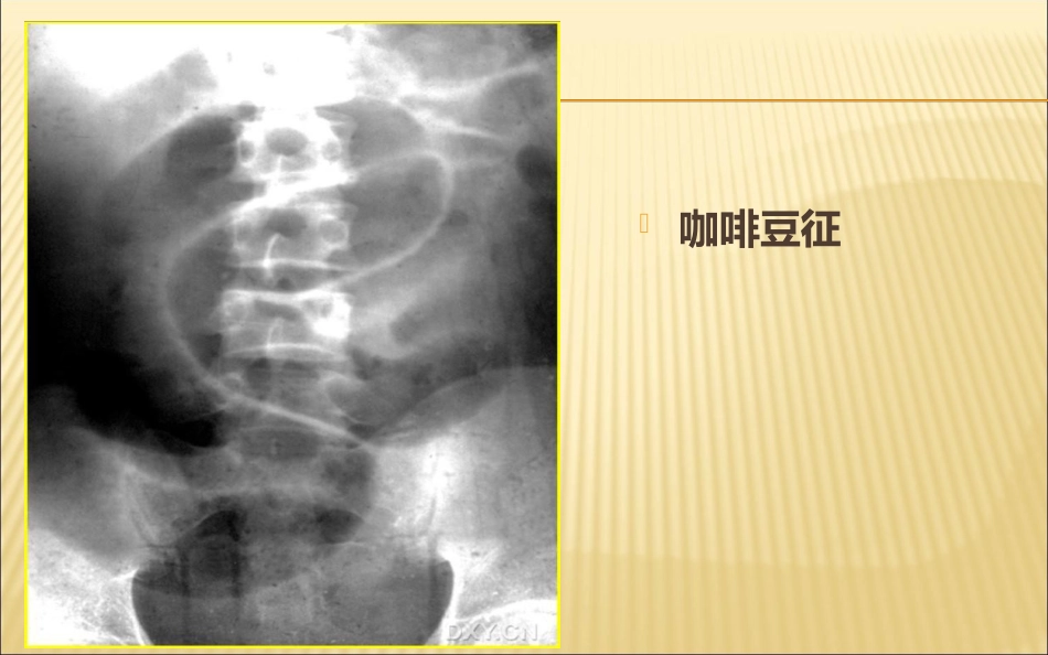 肠梗阻的影像诊断医学PPT_第15页