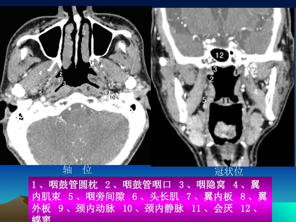 鼻咽癌影像学表现_第10页