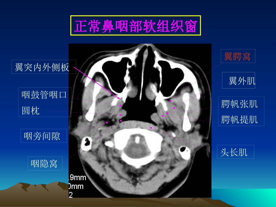 鼻咽癌影像学表现_第11页