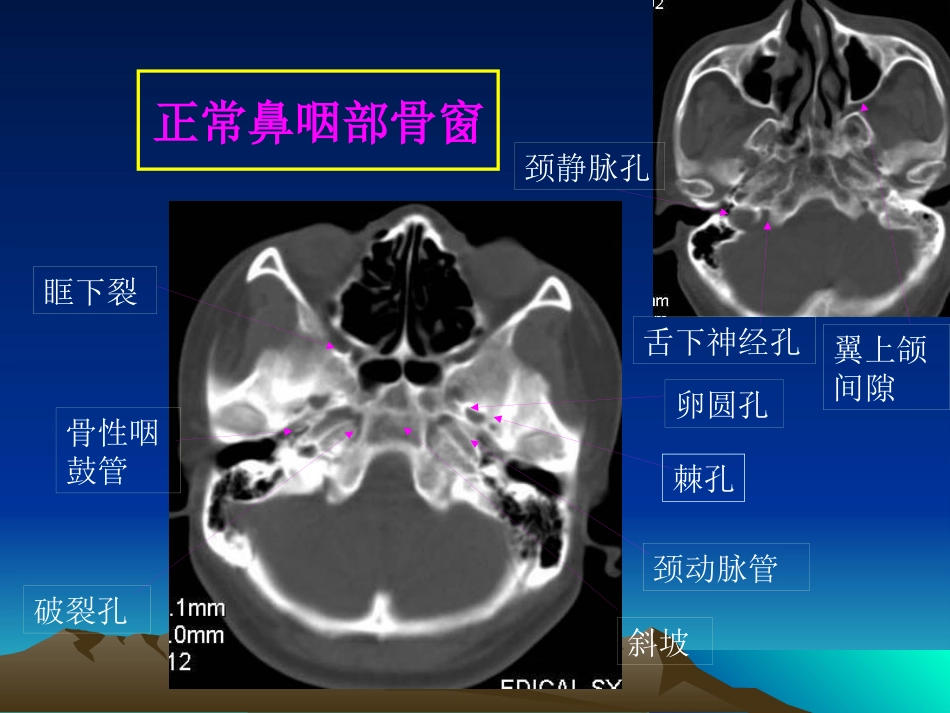 鼻咽癌影像学表现_第12页