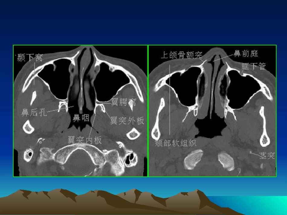 鼻咽癌影像学表现_第13页