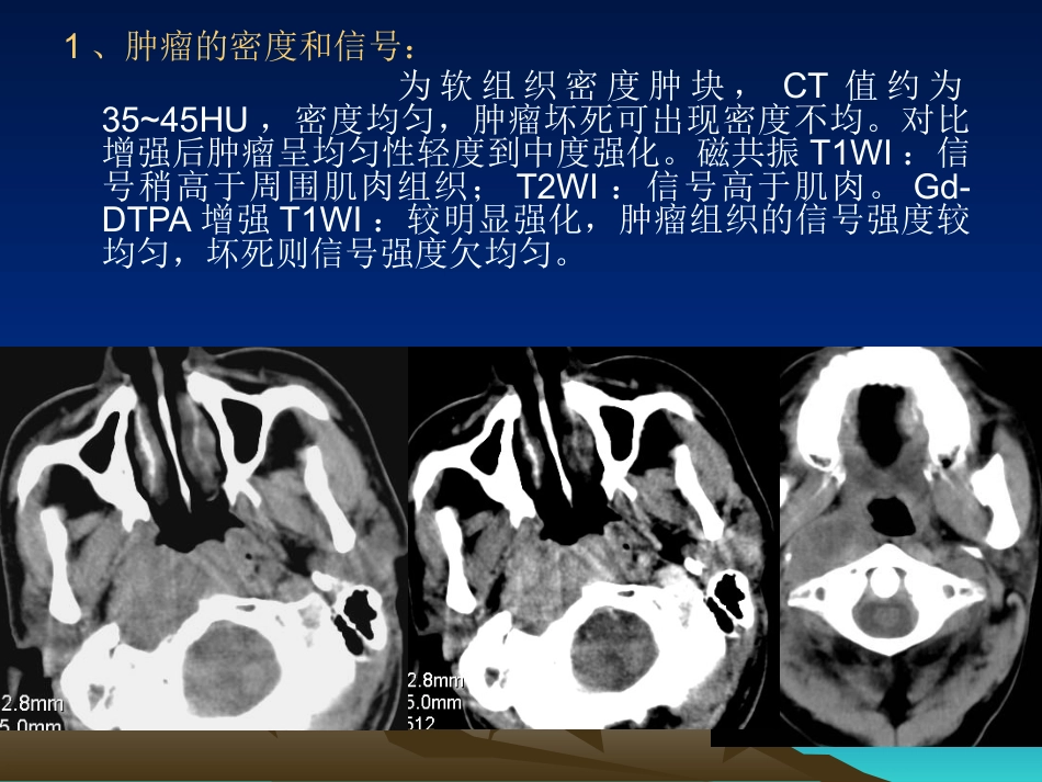 鼻咽癌影像学表现_第15页