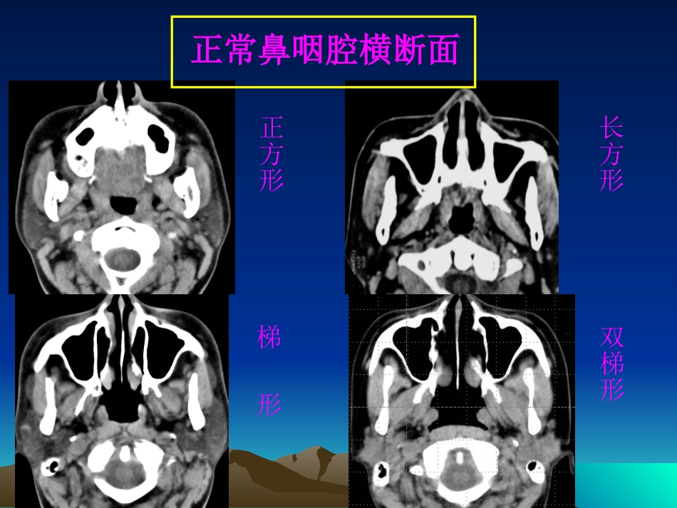 鼻咽癌影像学表现_第9页