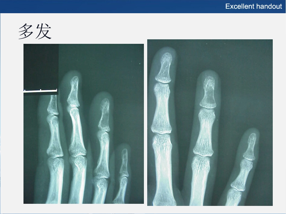 常见良性软骨类肿瘤的影像诊断_第12页