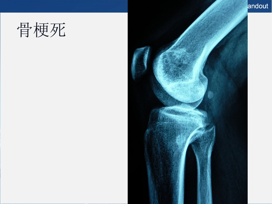 常见良性软骨类肿瘤的影像诊断_第14页
