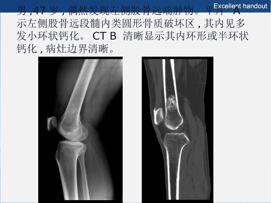 常见良性软骨类肿瘤的影像诊断_第15页